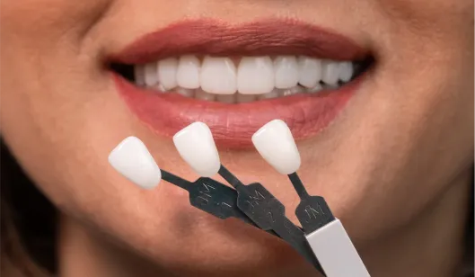 A close-up of a woman's smile showing bright white teeth, with three dental shade samples held near her lips.