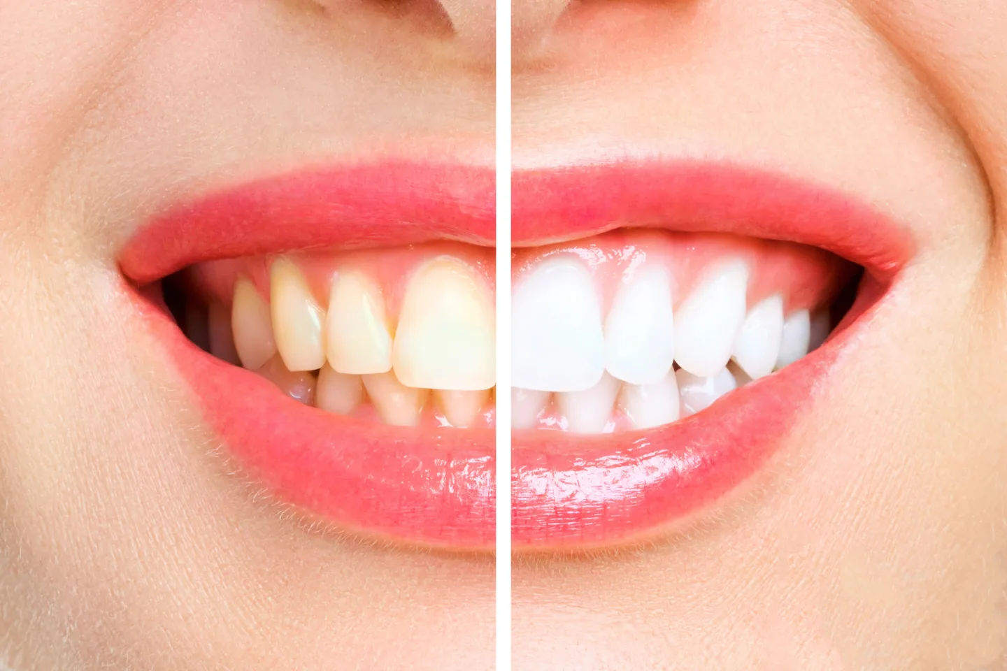 A close-up of a smiling face showing a side-by-side comparison of yellowed and whitened teeth.