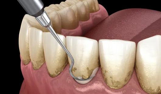 A dental instrument is cleaning plaque from the surface of teeth in a digital illustration of a mouth.