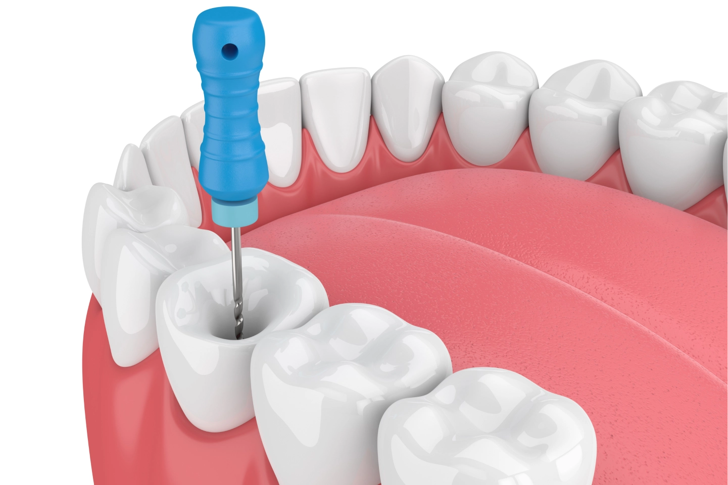 A dental drill is positioned above a cavity in a realistic depiction of a set of upper teeth and gums.