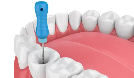 A dental drill positioned in a cavity of a 3D model of teeth and gums, illustrating dental procedures.