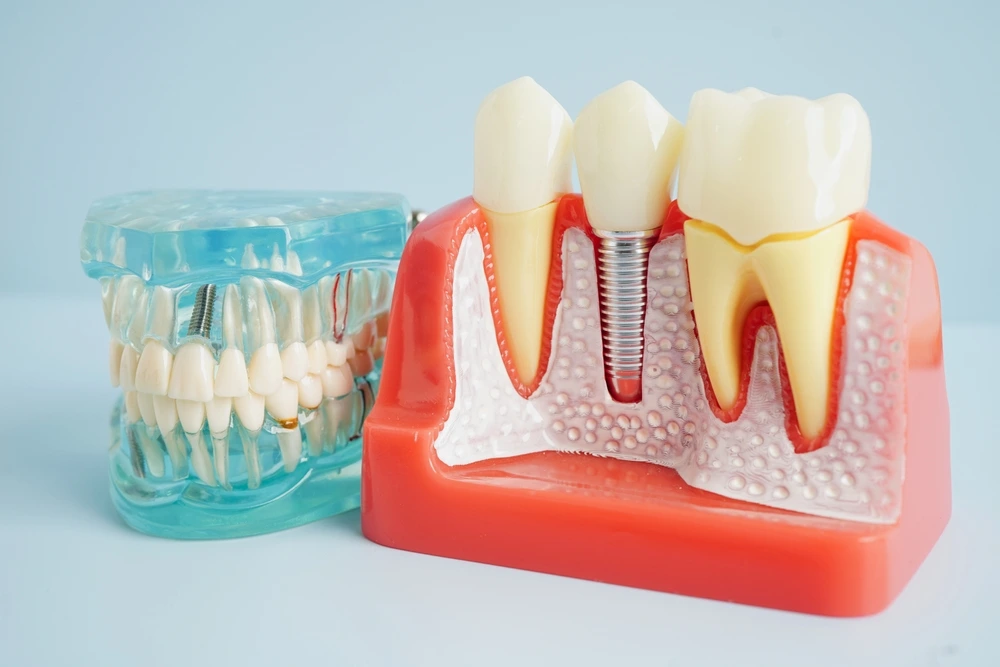 Dental models of a jaw with teeth and an implant model positioned on a light blue background.