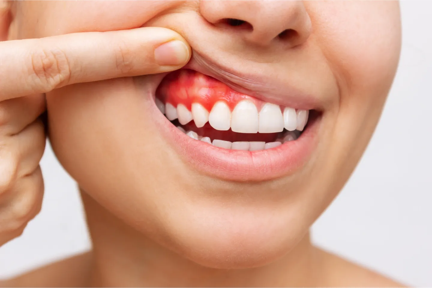 A person pointing to their red and inflamed gums, highlighting dental health concerns related to potential gum disease.