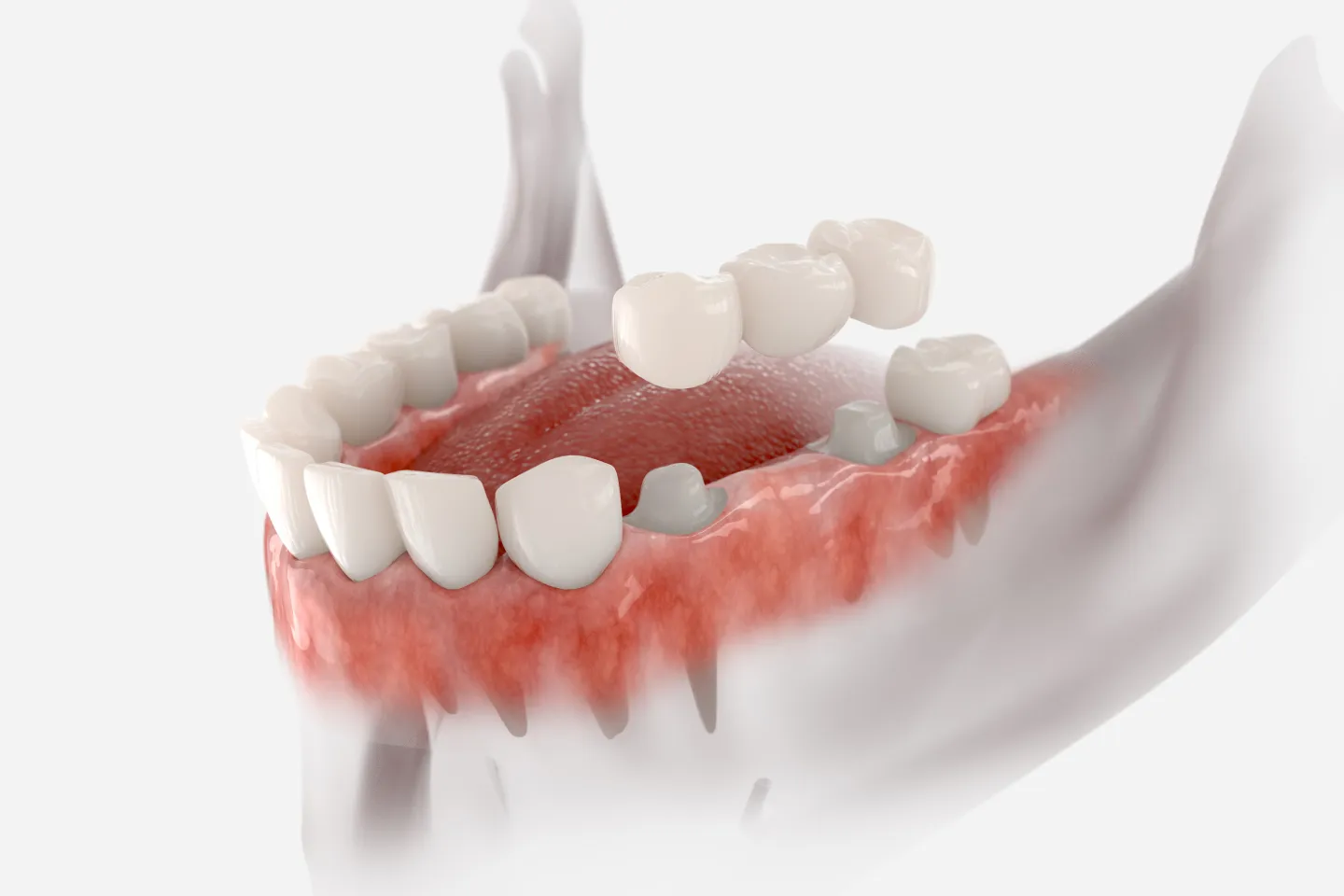 A 3D illustration of a dental structure showing teeth, gums, and a dental crown being placed in a treatment setting.