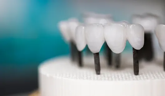 Dental crowns on black posts displayed on a white dental model against a blurred blue background.