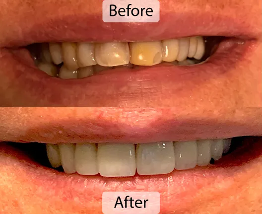 A comparison image showing a patient's teeth before and after dental treatment, highlighting improved brightness and alignment.