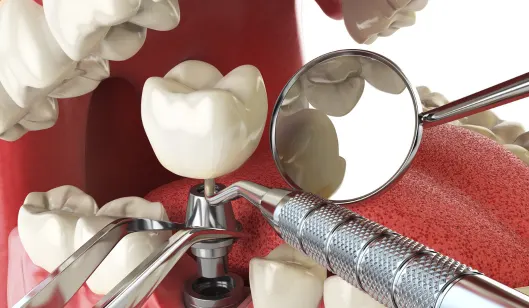 A dental implant being placed in a patient's jaw with dental tools and a mirror visible in the background.