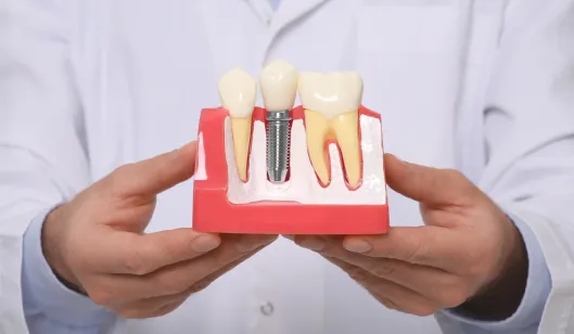 A dentist holding a dental implant model with adjacent natural teeth in a clinical setting.