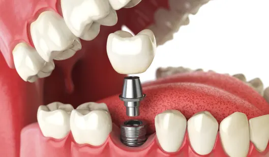 A dental implant being placed in a model of a mouth, showcasing the implant post and crown above it.