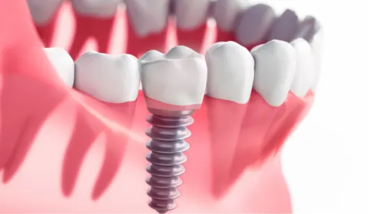 A dental implant positioned between natural teeth in a digital illustration of a human mouth.