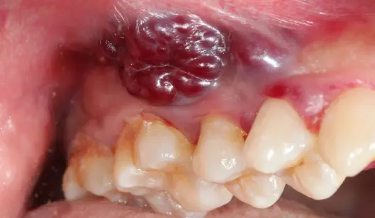 A close-up view of a dental cavity on a molar with inflamed gum tissue in a patient's mouth.