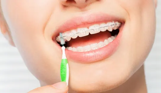 A person with braces brushing their teeth with a small toothbrush in a dental setting.
