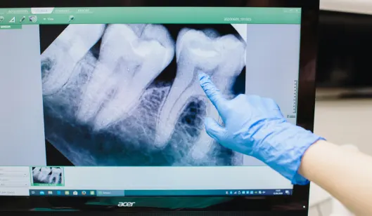 A gloved hand pointing at a dental X-ray displayed on a computer screen in a dental office.