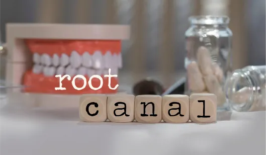 A model of teeth next to blocks spelling "root canal" and dental tools on a table, related to dental services.